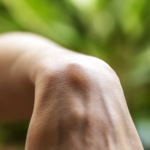 Ganglion (senknuta): symtom, orsak & behandling